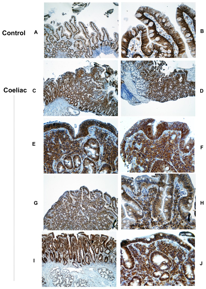 Syndecan-1 (CD138) expression in normal and coeliac mucosa using monoclonal MCA2459GA. A. Expression within normal intestine, showing syndecan-1 localises predominantly to the basolateral epithelial surface (original magnification x10). B. Higher power view (x40) of normal duodenum, showing similar epithelial localisation plus the presence of scattered syndecan-1+ plasma cells within the lamina propria. C,D. Low power view (x10) of 2 cases of coeliac disease, showing retention of epithelial staining similar to controls, plus additionally a dense confluent expression within the upper lamina propria. E,F. Higher power view (x40) of the subepithelial region in these cases. The lamina propria aggregates consist of cells with dense membrane staining (plasma cells), cells with recognisable nuclei and punctate cytoplasmic staining and scattered syndecan-1+ debris (shed ectodomains)